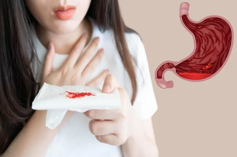 Phân đen có thể là dấu hiệu của xuất huyết đường tiêu hóa trên
