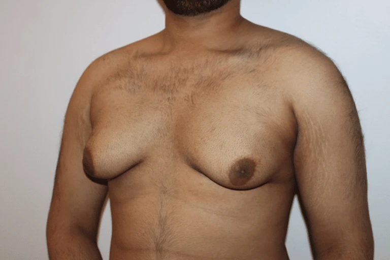 Nữ hóa tuyến vú ở bệnh nhân nam bị thừa Estrogen tương đối