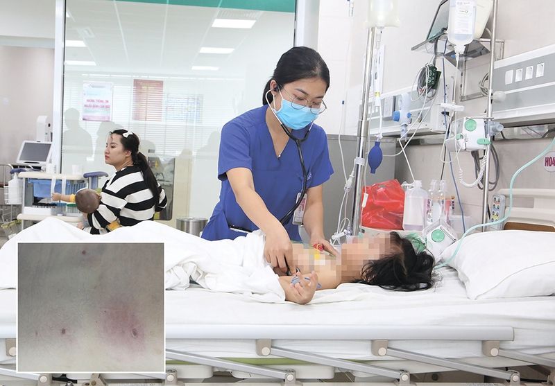 Chườm lạnh có thể giúp giảm sưng và làm dịu cảm giác đau rát tại vị trí bị ong đốt.