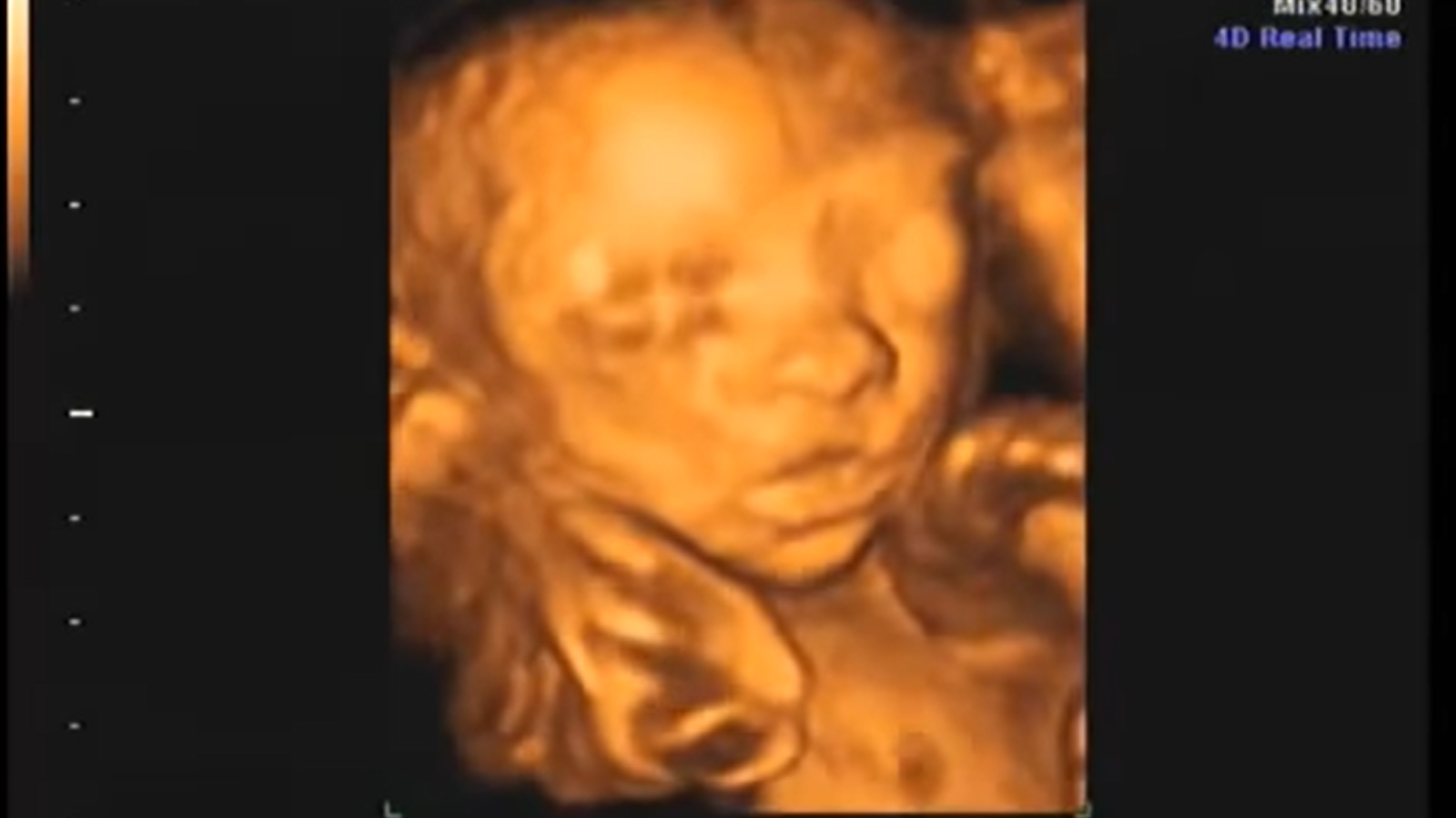 Siêu âm 4d thai 22 tuần giai đoạn quan trọng trong sự phát triển của thai  nhi