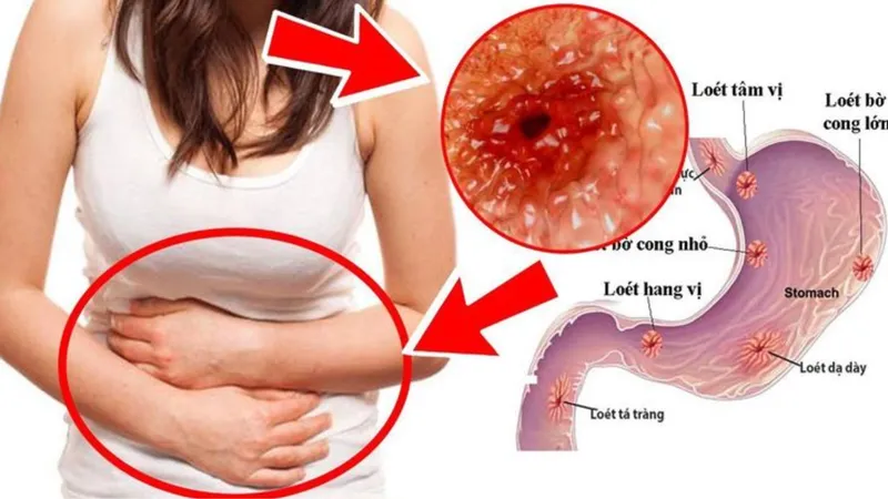 Vị trí hành tá tràng tiếp giáp với môn vị dạ dày. 