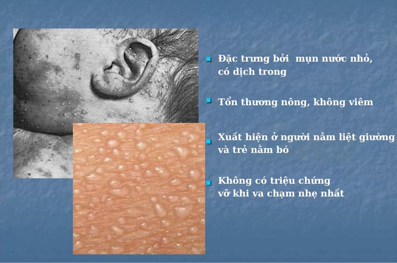 Rôm sảy ở cổ: nguyên nhân, triệu chứng và cách điều trị