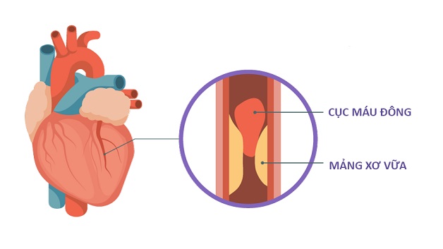 Các động mạch vành ở tim nếu bị xơ vữa có thể gây tắc nghẽn, nhồi máu cơ tim rất nguy hiểm.