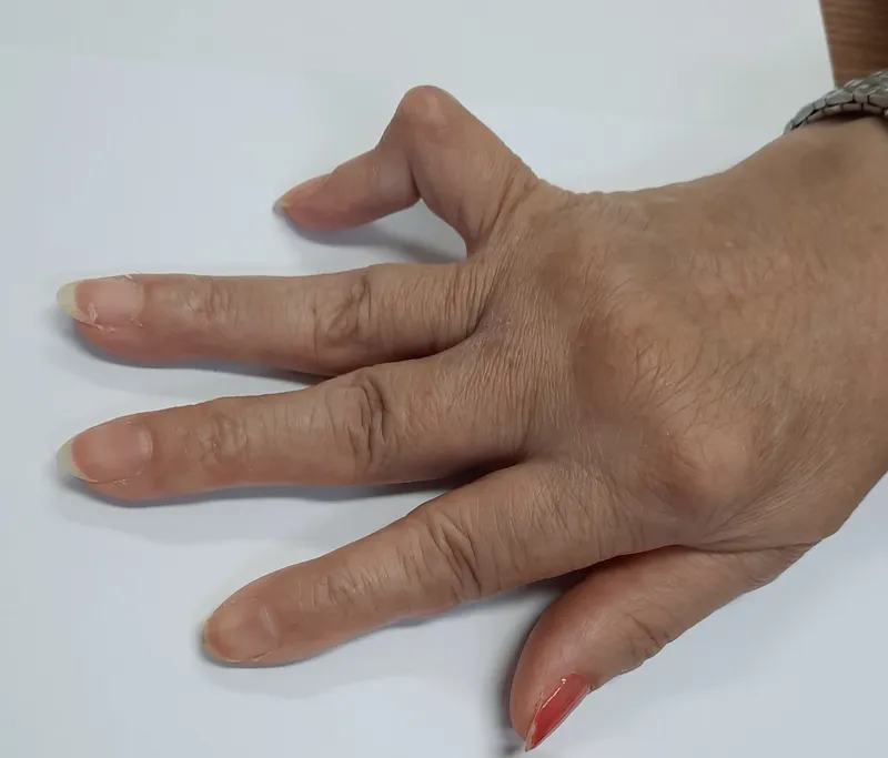 Trật khớp cổ tay thường gặp ở vận động viên và người có nguy cơ té ngã cao 