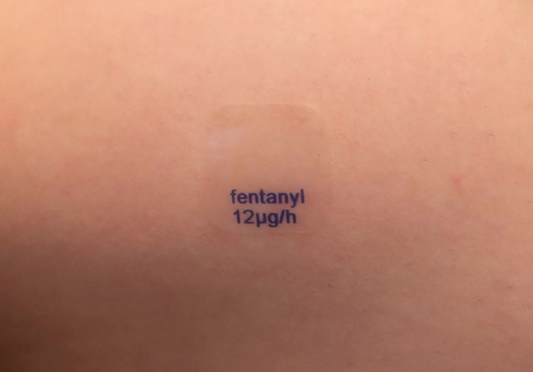 Miếng dán giảm đau Fentanyl 12mcg/h