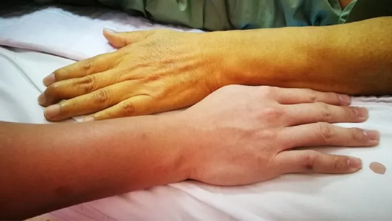 Tình trạng vàng da và vàng mắt là dấu hiệu cho thấy chức năng thải độc bilirubin của gan đã suy giảm nghiêm trọng 