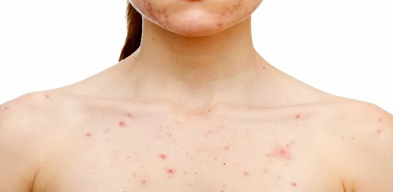 Nhiễm siêu vi hoặc sốt phát ban có thể gây nổi mẩn đỏ không ngứa