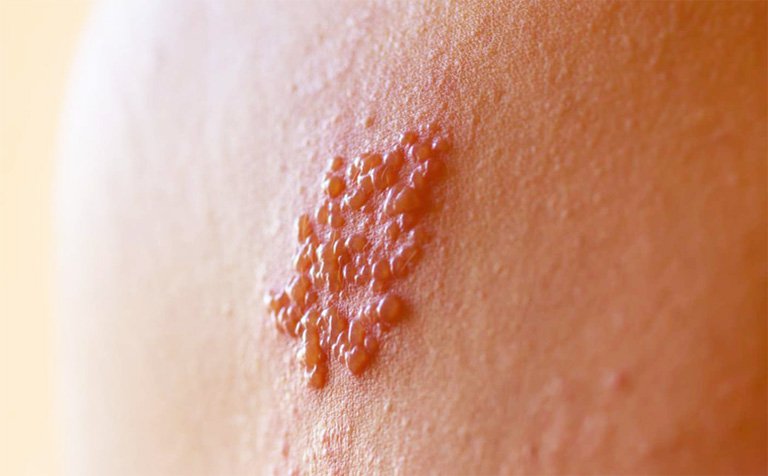 Bệnh Zona thần kinh hay còn gọi là zona hoặc herpes zoster, trong dân gian hay gọi là “giời leo”.  