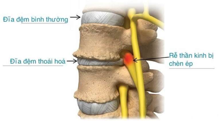 Thoái hóa đĩa đệm là một trong những nguyên nhân dẫn đến gai cột sống