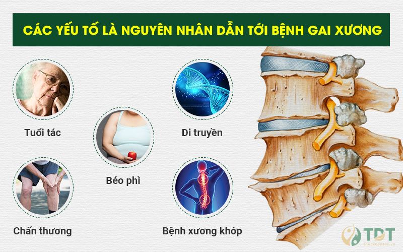 Đối tượng nguy cơ bị gai xương