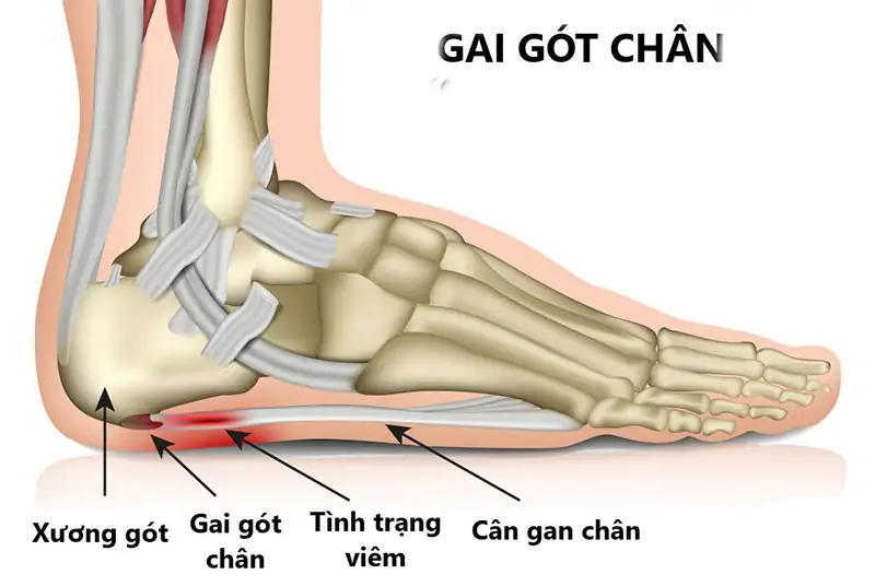 Điều trị gai xương