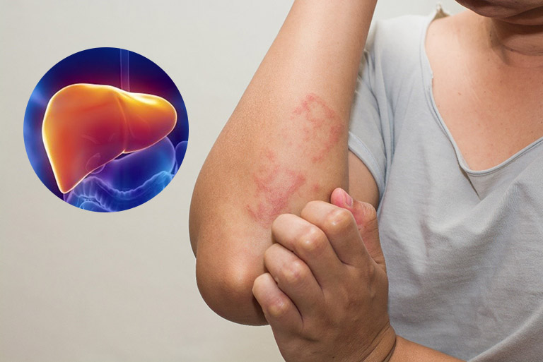 Mề đay, ngứa ngáy có thể là triệu chứng khi men gan tăng cao