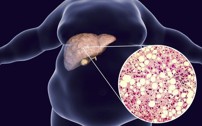 Dấu hiệu sớm của bệnh gan nhiễm mỡ