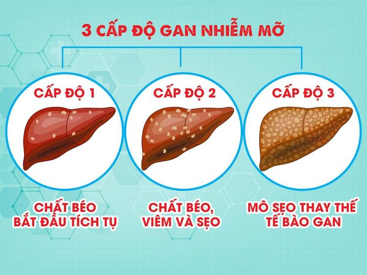 Các cấp độ gan nhiễm mỡ