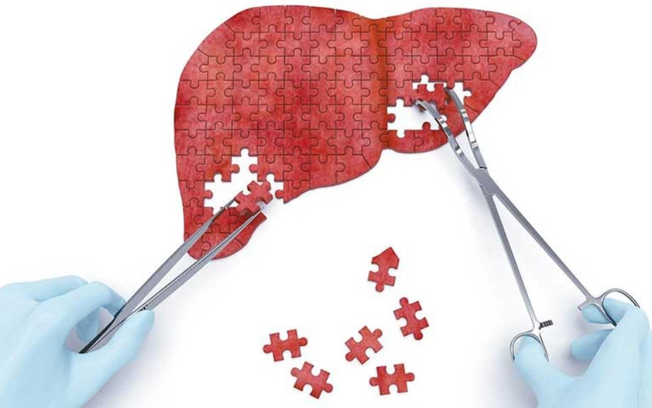 Phương pháp điều trị suy gan mạn