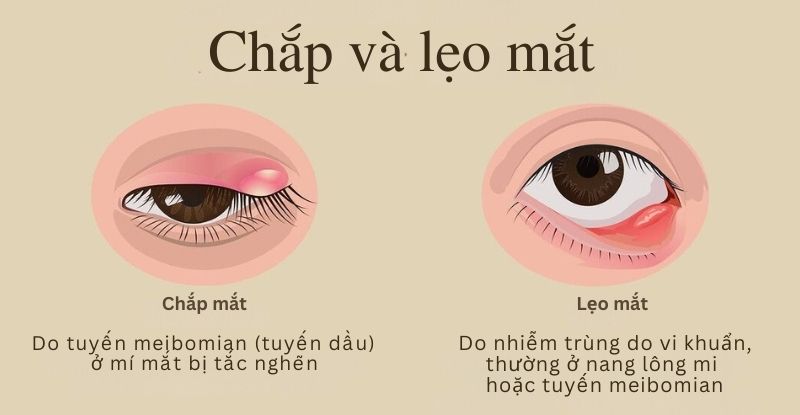 Hình minh họa khối sưng ở mí mắt là dấu hiệu thường gặp của chắp mắt