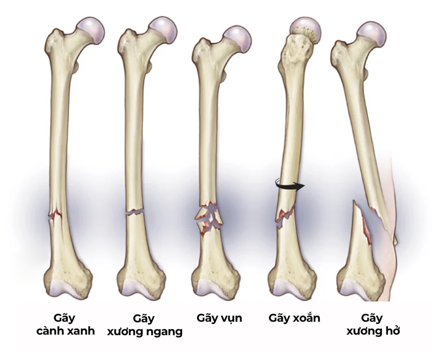 Một số loại gãy xương phổ biến