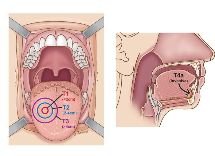 Các giai đoạn của ung thư lưỡi