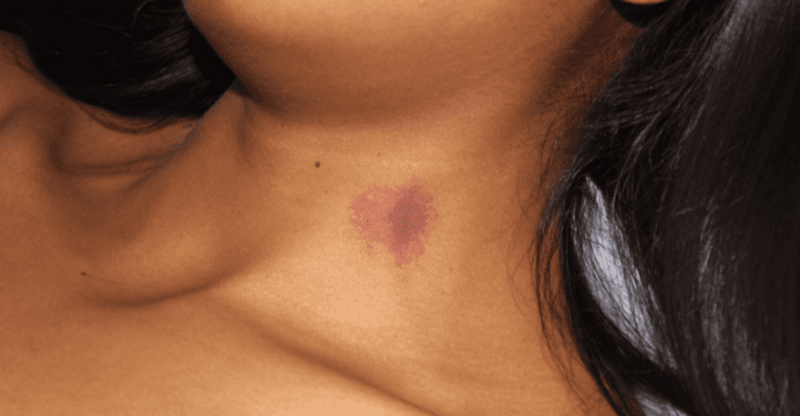 Hickey là gì? Tìm hiểu chi tiết về dấu hickey và ý nghĩa trong tình yêu