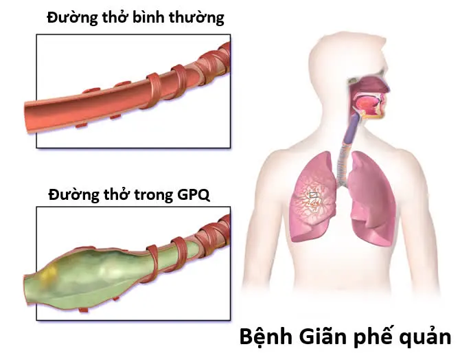 Giãn phế quản là sự giãn nở bất thường của các phế quản