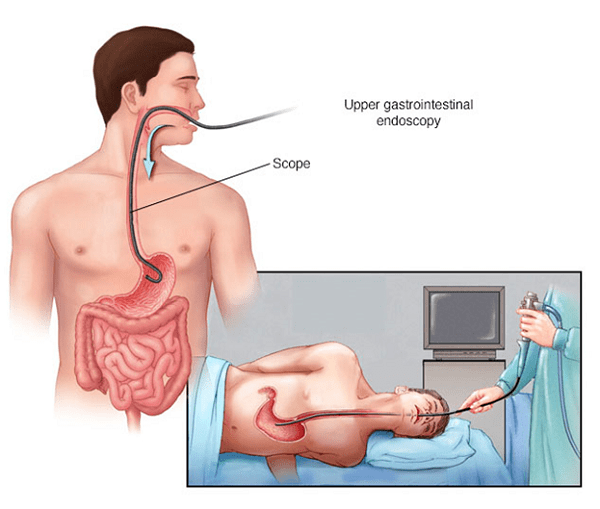 Chẩn đoán giãn tĩnh mạch thực quản bằng phương pháp nội soi thực quản