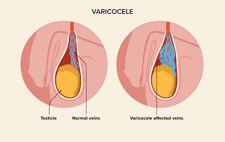 Giãn tĩnh mạch thừng tinh (Varicocele)