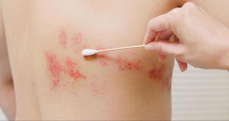 Cách trị giời leo cần sự kết hợp giữa thuốc kháng virus, thuốc giảm đau và các biện pháp chăm sóc bên ngoài