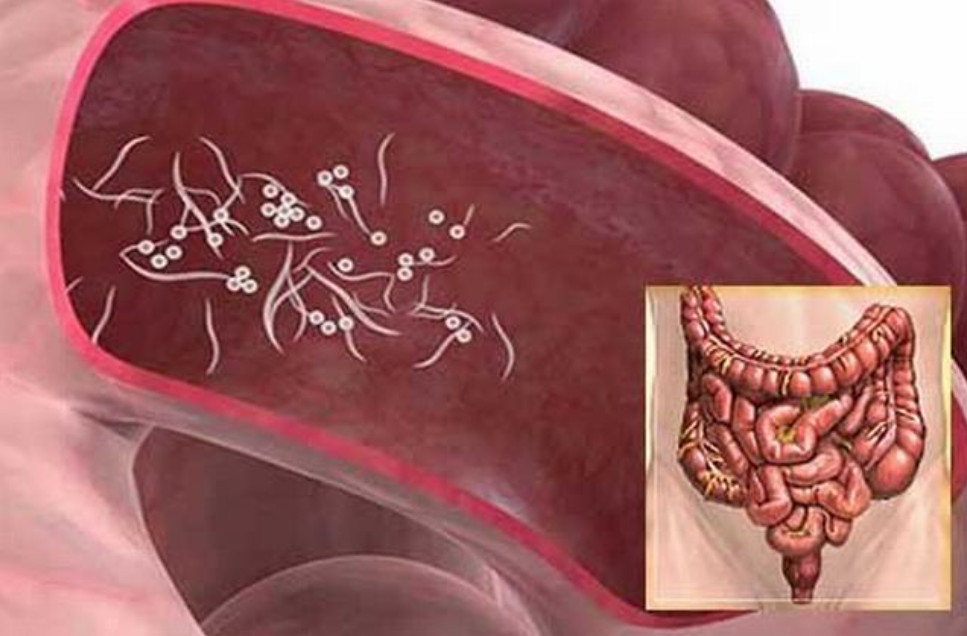 Giun sán là gì? Những điều cần biết về giun sán