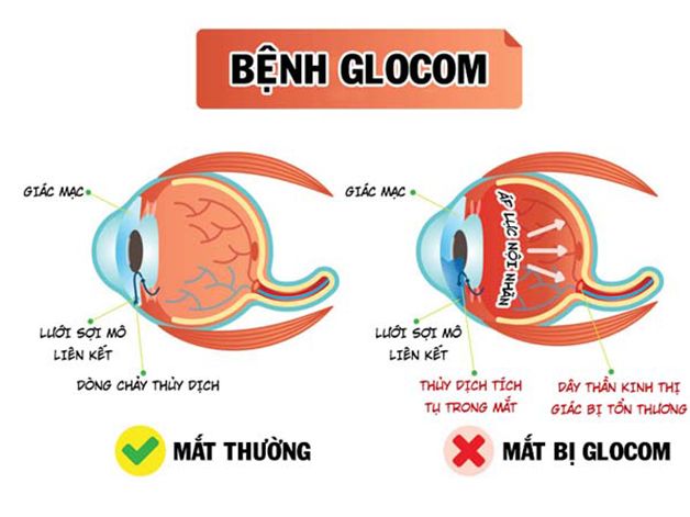 So sánh giữa mắt thường và mắt bị glocom