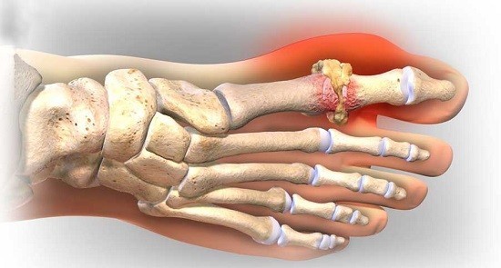 Bệnh Gout (bệnh gút) là một trong những dạng viêm khớp gây đau đớn nhất.