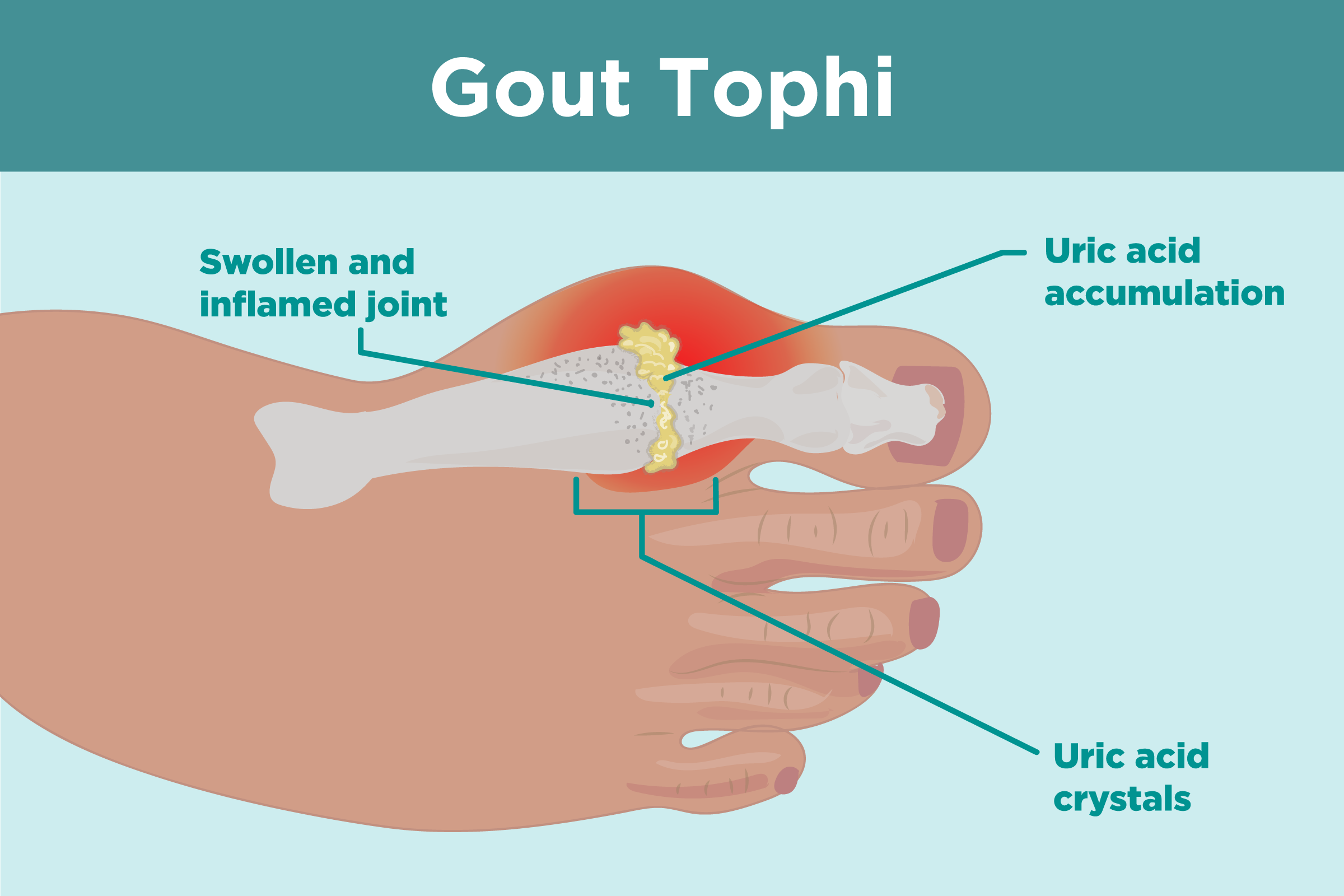 Gout mãn tính gây ra đau đớn và ảnh hưởng đến đời sống thường ngày