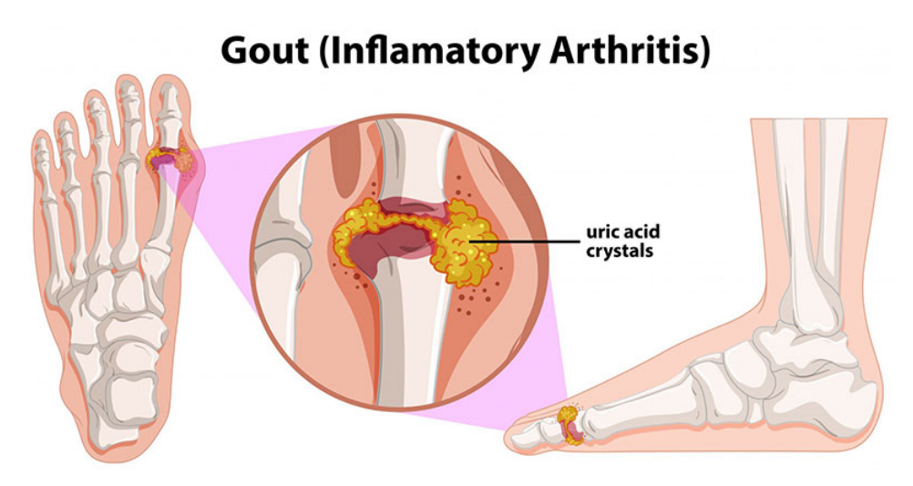 Bệnh nhân có thể cảm thấy đau nhức ở các khớp xương bị sưng viêm
