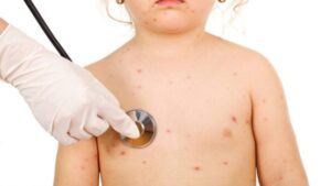 Cha mẹ nên cho trẻ thăm khám sớm để có biện pháp điều trị xuất huyết giảm tiểu cầu kịp thời
