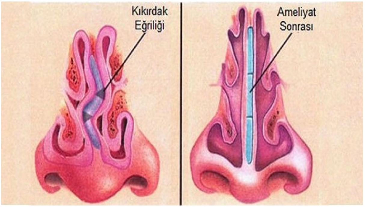 Lệch vách ngăn mũi cũng là một trong những yếu tố khiến bạn bị viêm xoang sàng