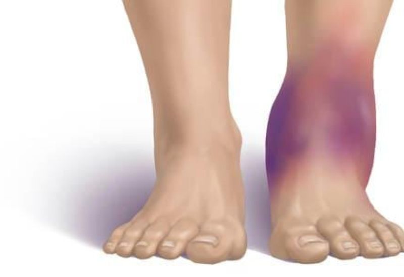 Cổ chân bị đau và sưng tím là dấu hiệu của việc bị bong gân