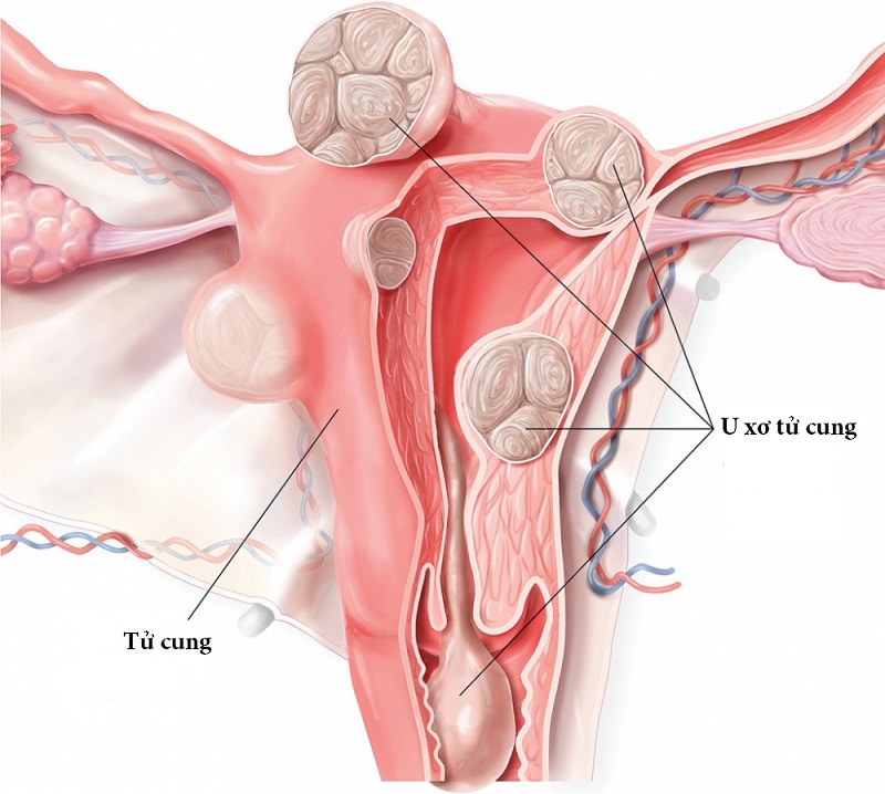 U xơ tử cung phái đẹp