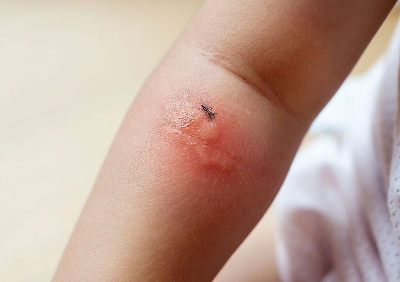 Sát trùng vết đốt, không gãi mạnh và theo dõi sốt trong 14 ngày.