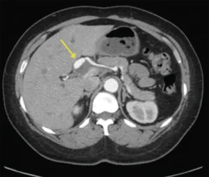 Chụp X quang có thể chẩn đoán được bệnh phình động mạch gan