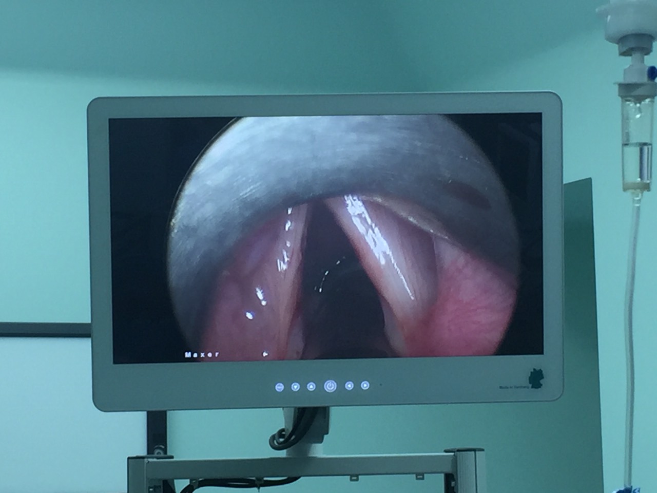 Chẩn đoán hạt xơ dây thanh quản