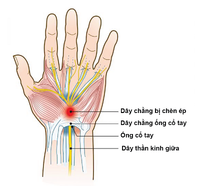 Hội chứng ống cổ tay do nhiều nguyên nhân gây ra cần được phát hiện sớm và điều trị kịp thời hiệu quả