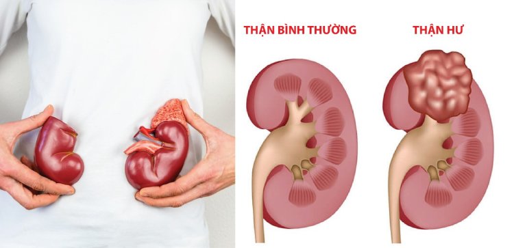 9. Dinh dưỡng chuyên biệt cho các thể bệnh thận liên quan