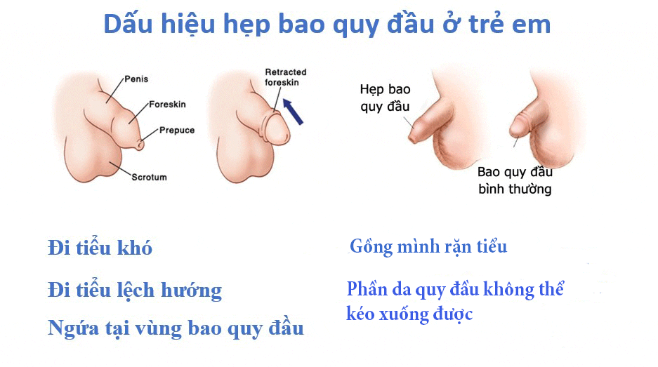 Dấu hiệu hẹp bao quy đầu ở trẻ em