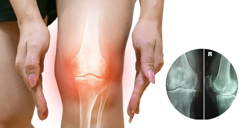 Hẹp khe khớp gối là một dạng tổn thương thực thể của bệnh thoái hóa khớp gối