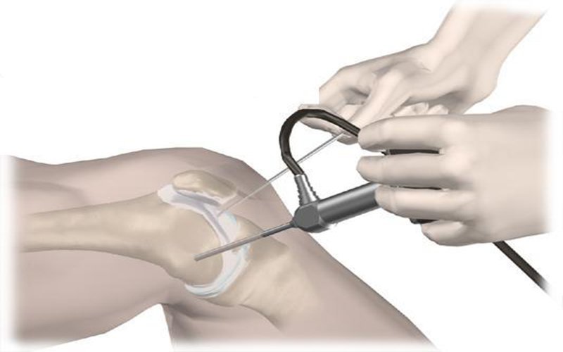 Điều trị bằng nội soi đem lại hiệu quả tốt cho bệnh nhân thoái hóa và hẹp khe khớp gối