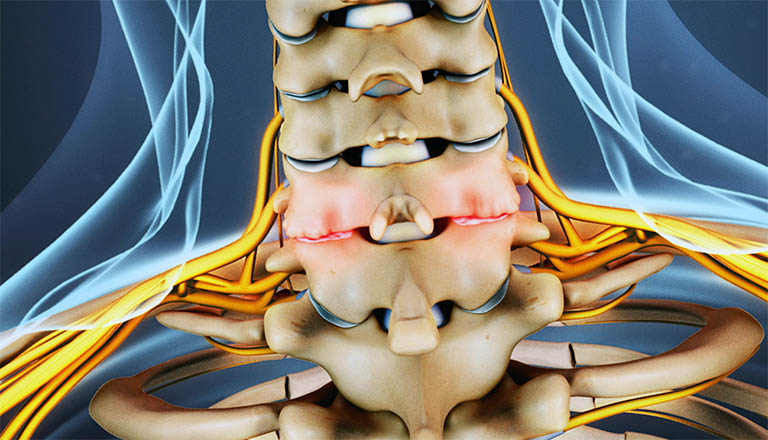 Chẩn đoán hẹp lỗ liên hợp đốt sống cổ