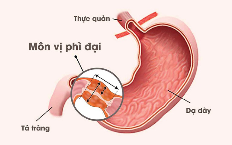 Hẹp môn vị phì đại
