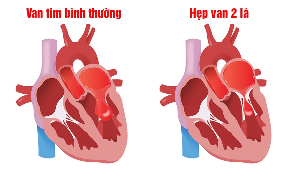 Tim bình thường và tim mắc bệnh hẹp van hai lá