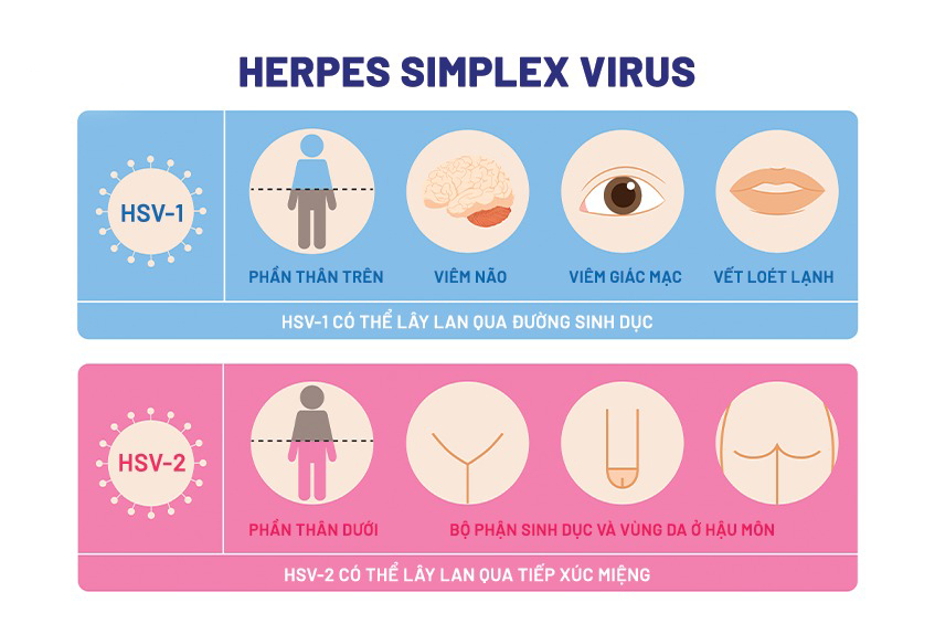 Virus herpes simplex gồm 2 loại HSV-1 và HSV-2 