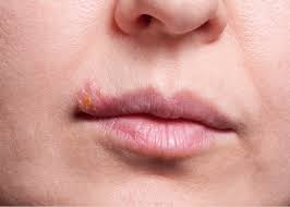 Dấu hiệu nhận biết Herpes môi