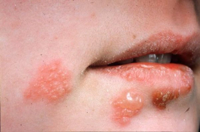 Mụn nước nhỏ quanh vùng môi là triệu chứng điển hình của herpes môi